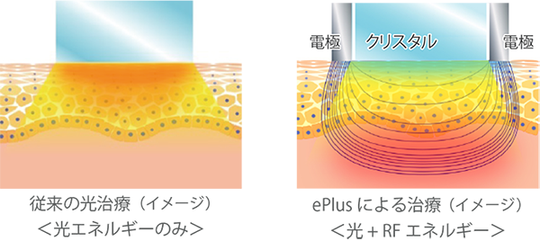 従来の光治療（イメージ） 光エネルギーのみ　ePlusによる治療（イメージ） 光 + RFエネルギー