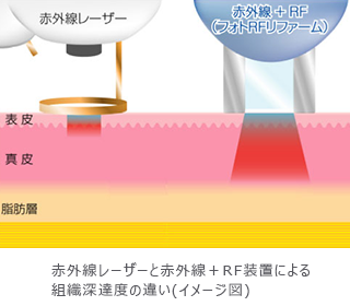 赤外線レーザーと赤外線+RF装置による組織深達度の違い